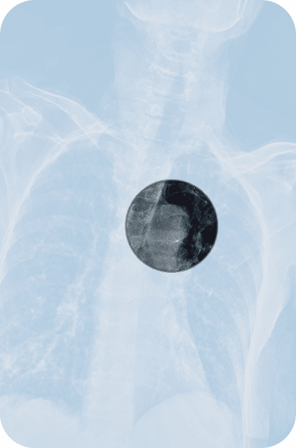 X-ray of a chest area
