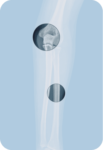 Immagine radiografica che mostra il gomito