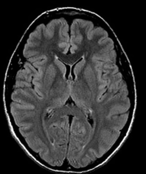 多发性硬化与白质病变MRI