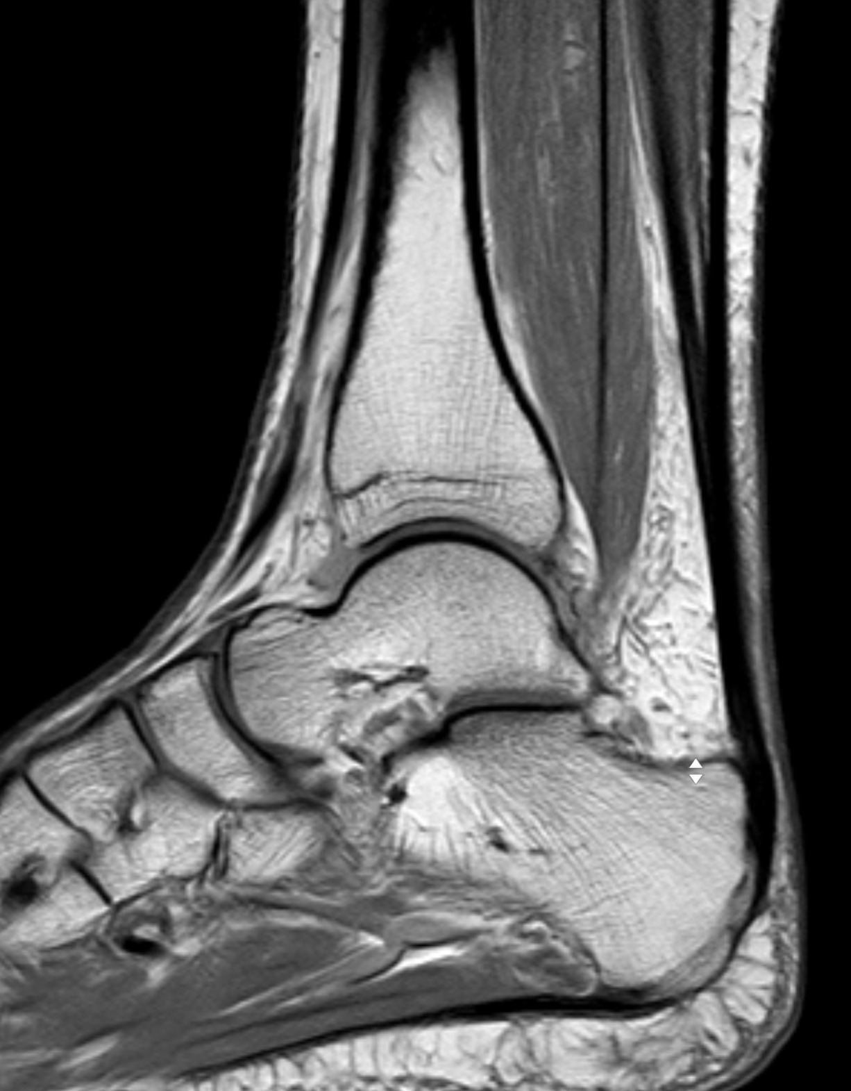 Ankle & Foot MRI