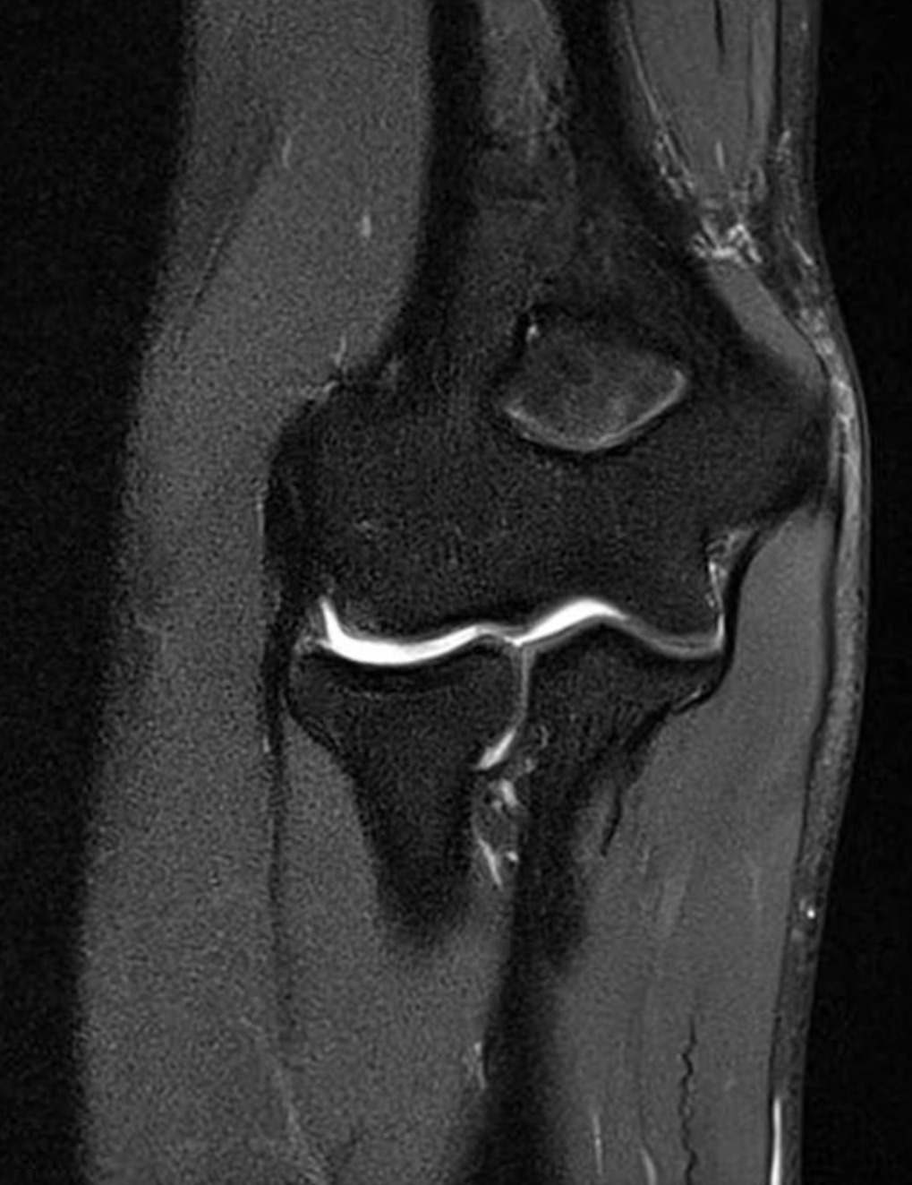 Elbow MRI