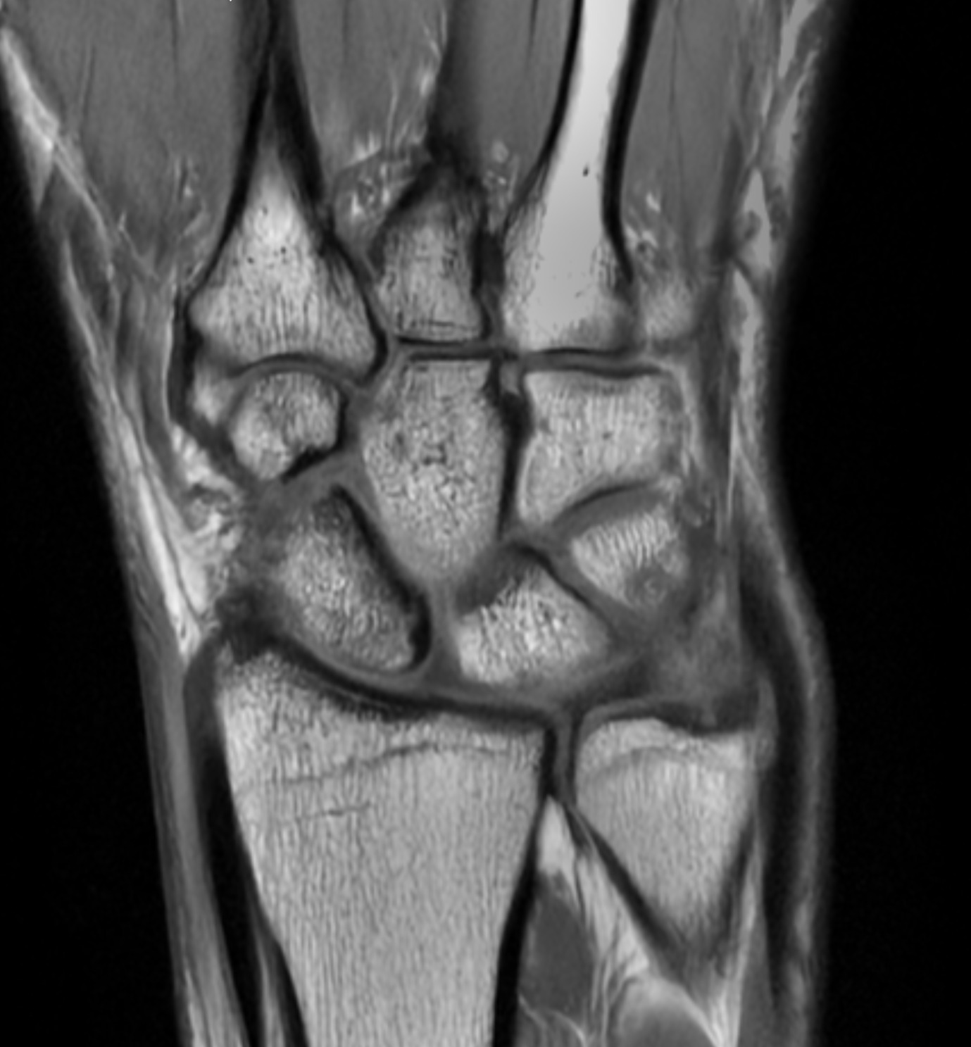 Hand & Wrist MRI