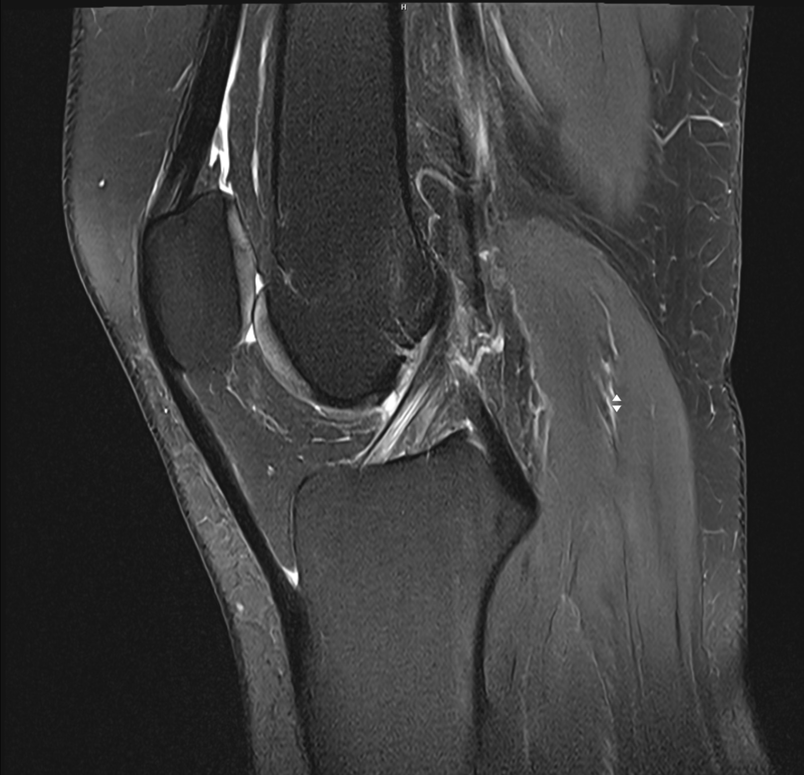 Knee MRI