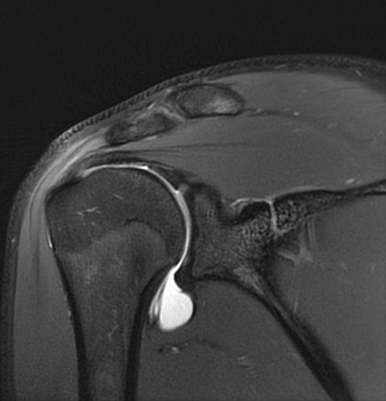 Shoulder MRI
