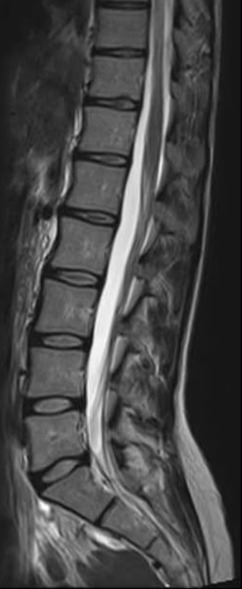 Spine MRI